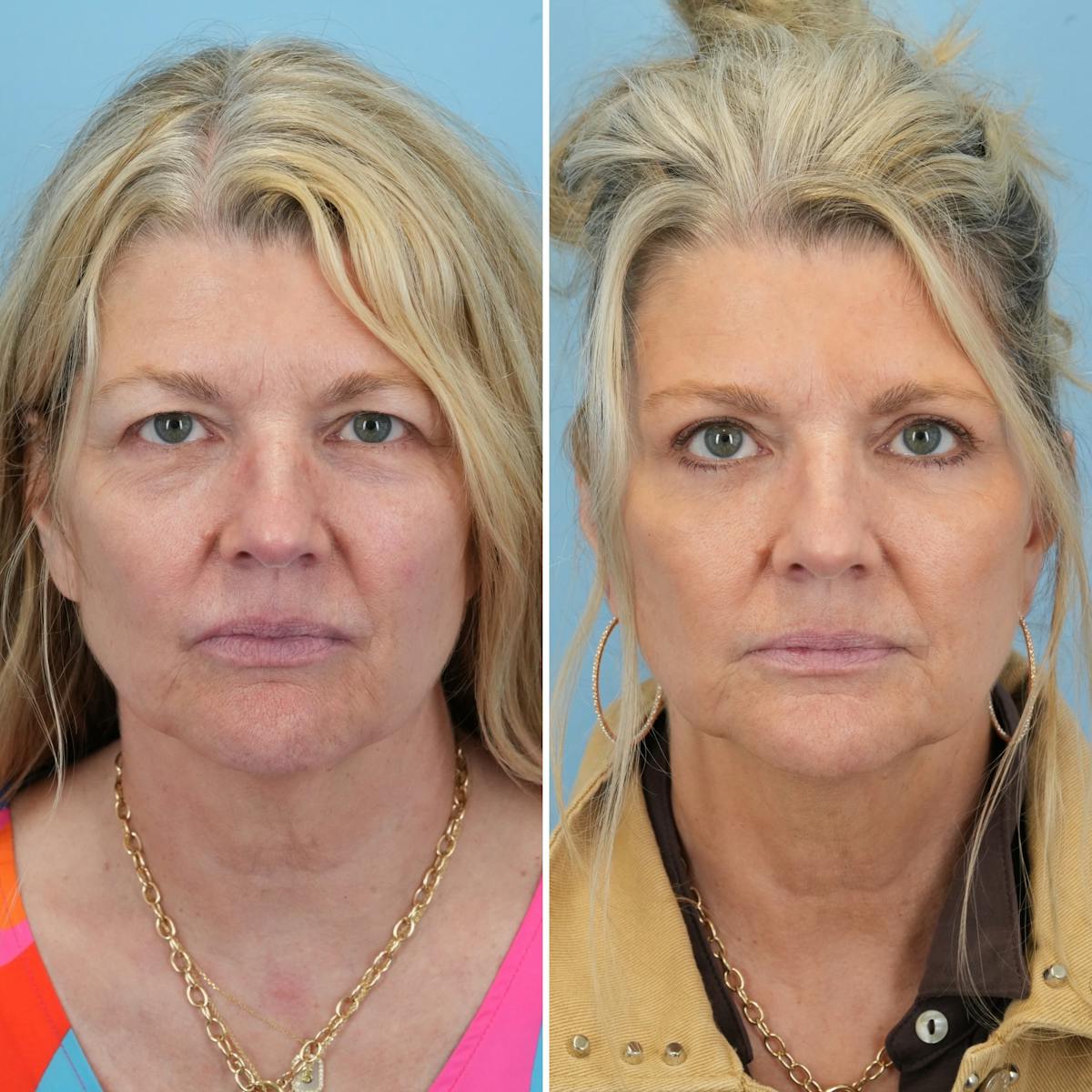 Blepharoplasty Before & After Gallery - Patient 323272 - Image 5