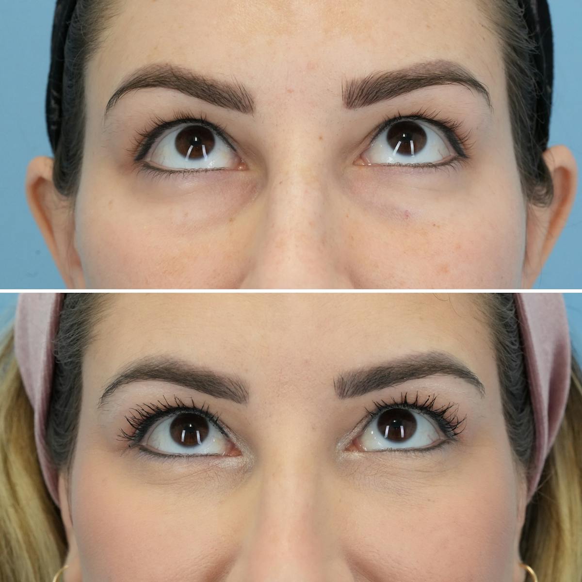 Blepharoplasty Before & After Gallery - Patient 173125 - Image 2