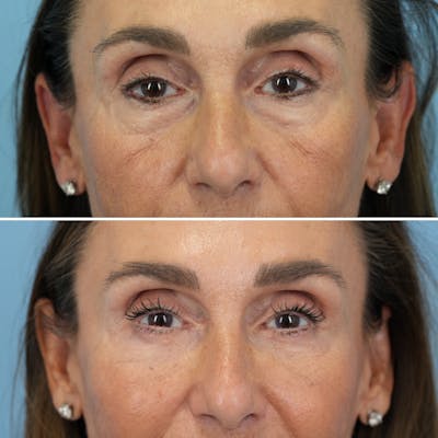 Blepharoplasty Before & After Gallery - Patient 348171 - Image 1