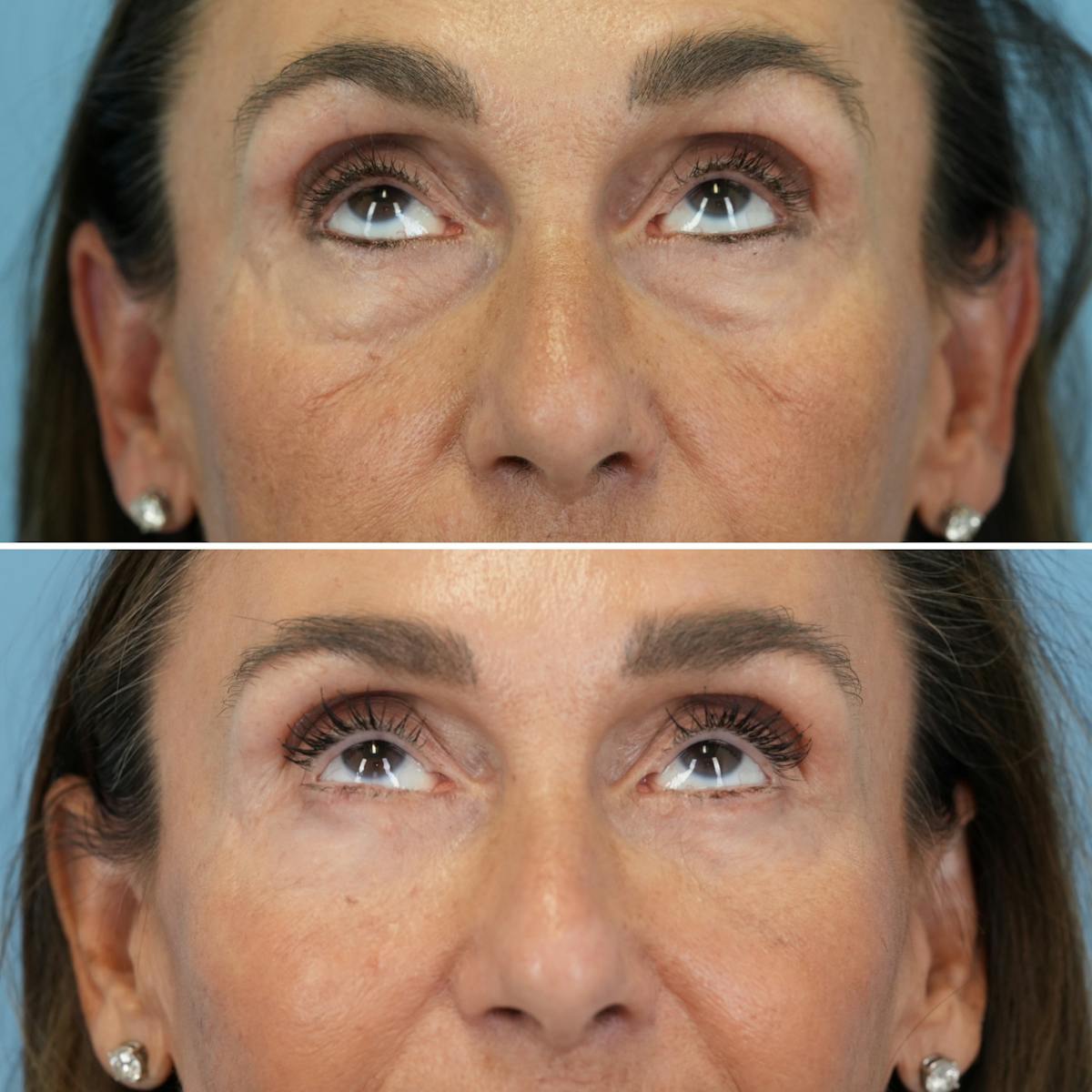 Blepharoplasty Before & After Gallery - Patient 348171 - Image 2