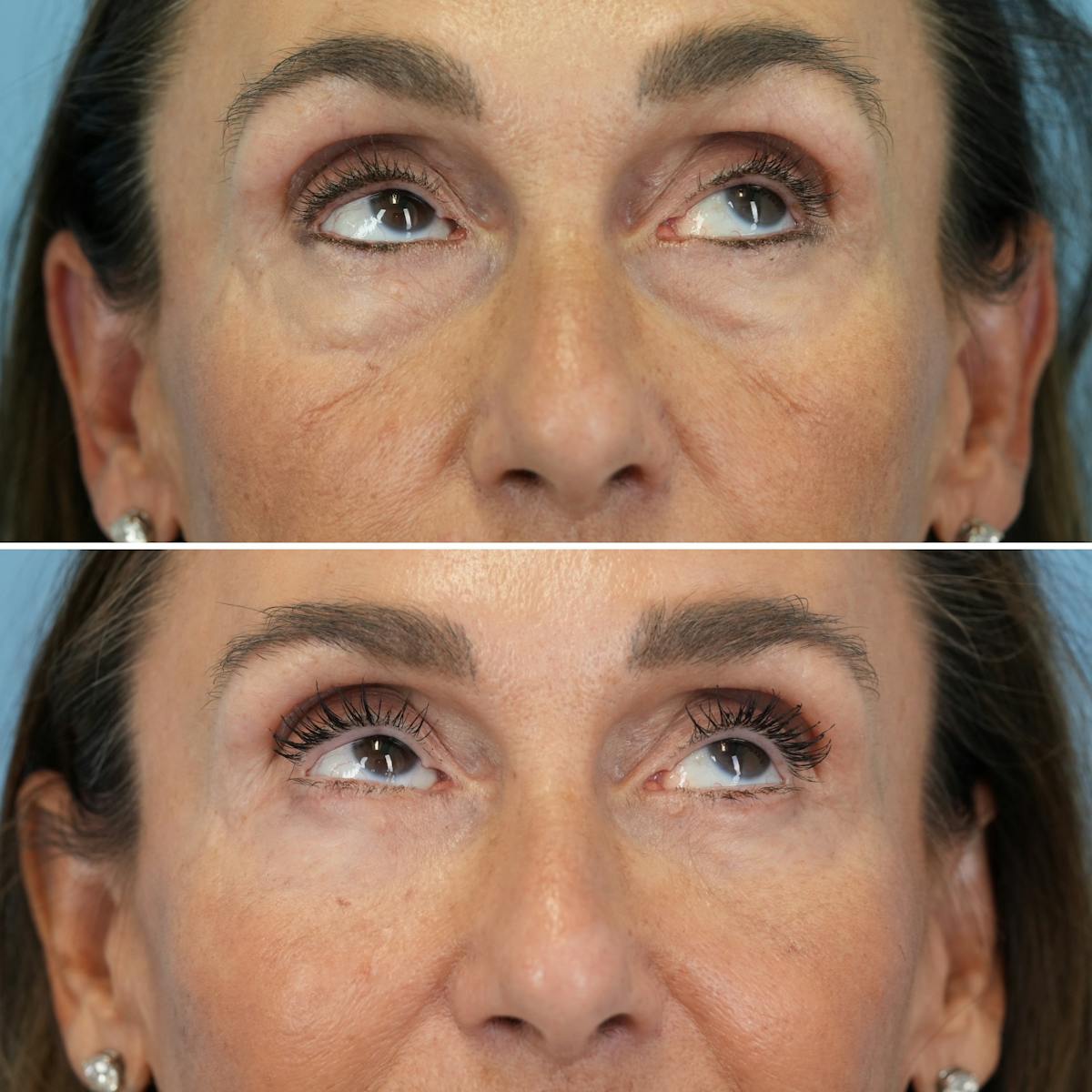 Blepharoplasty Before & After Gallery - Patient 348171 - Image 3