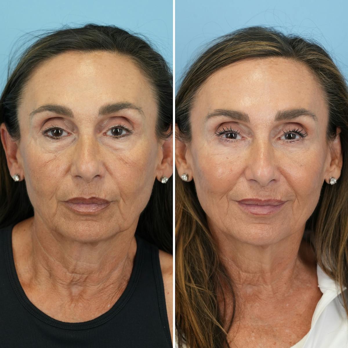 Blepharoplasty Before & After Gallery - Patient 348171 - Image 5