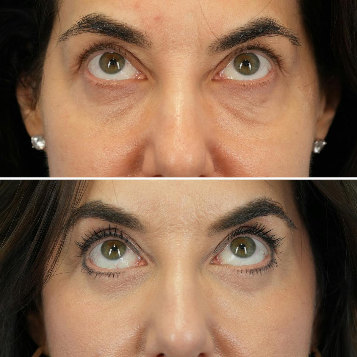 Blepharoplasty Before & After Gallery - Patient 324230 - Image 2