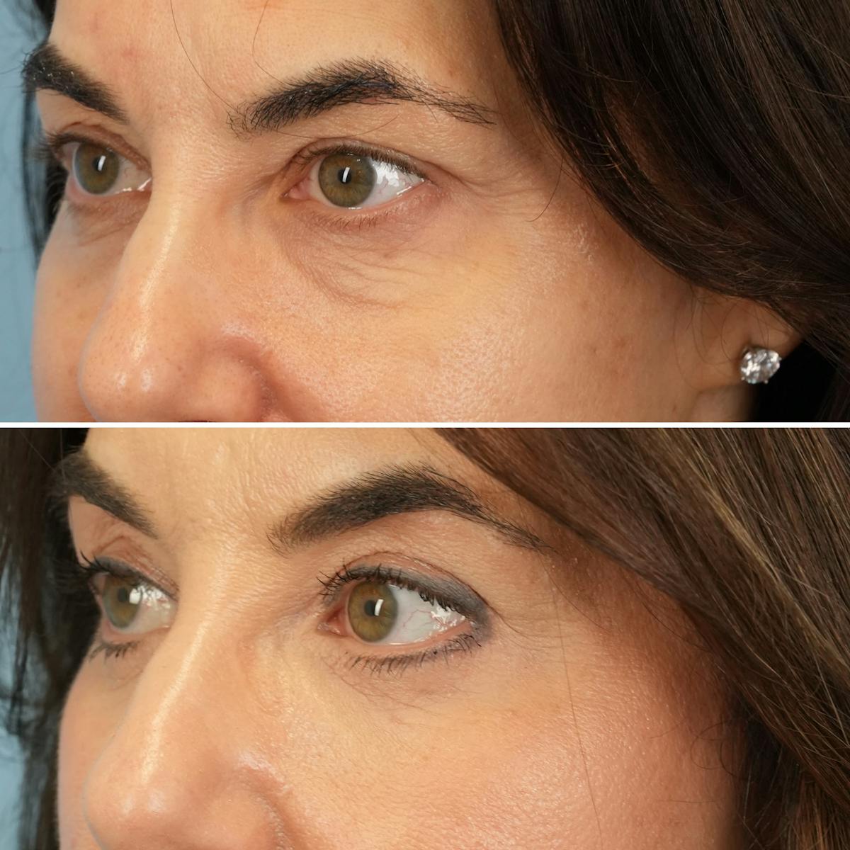 Blepharoplasty Before & After Gallery - Patient 324230 - Image 5