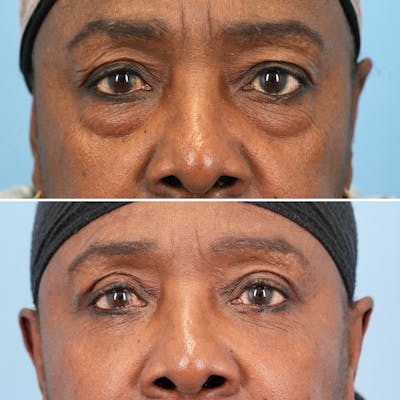 Blepharoplasty Before & After Gallery - Patient 189328 - Image 1