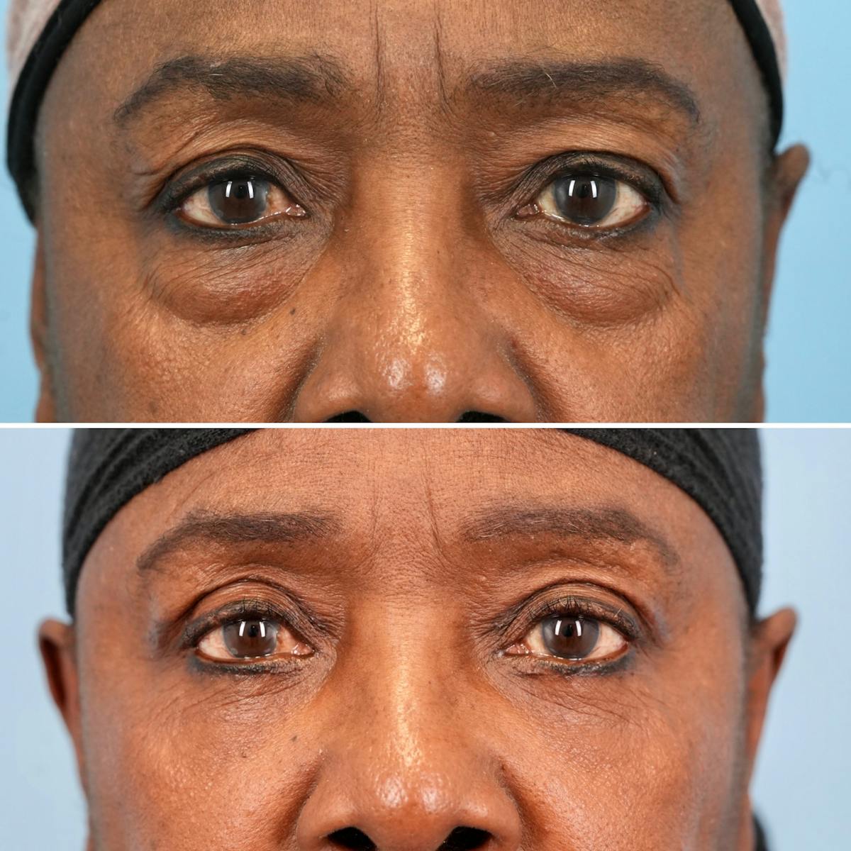 Blepharoplasty Before & After Gallery - Patient 189328 - Image 2