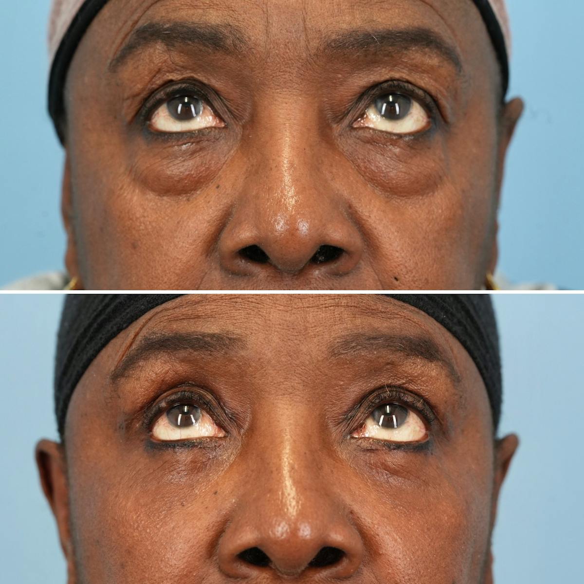 Blepharoplasty Before & After Gallery - Patient 189328 - Image 3