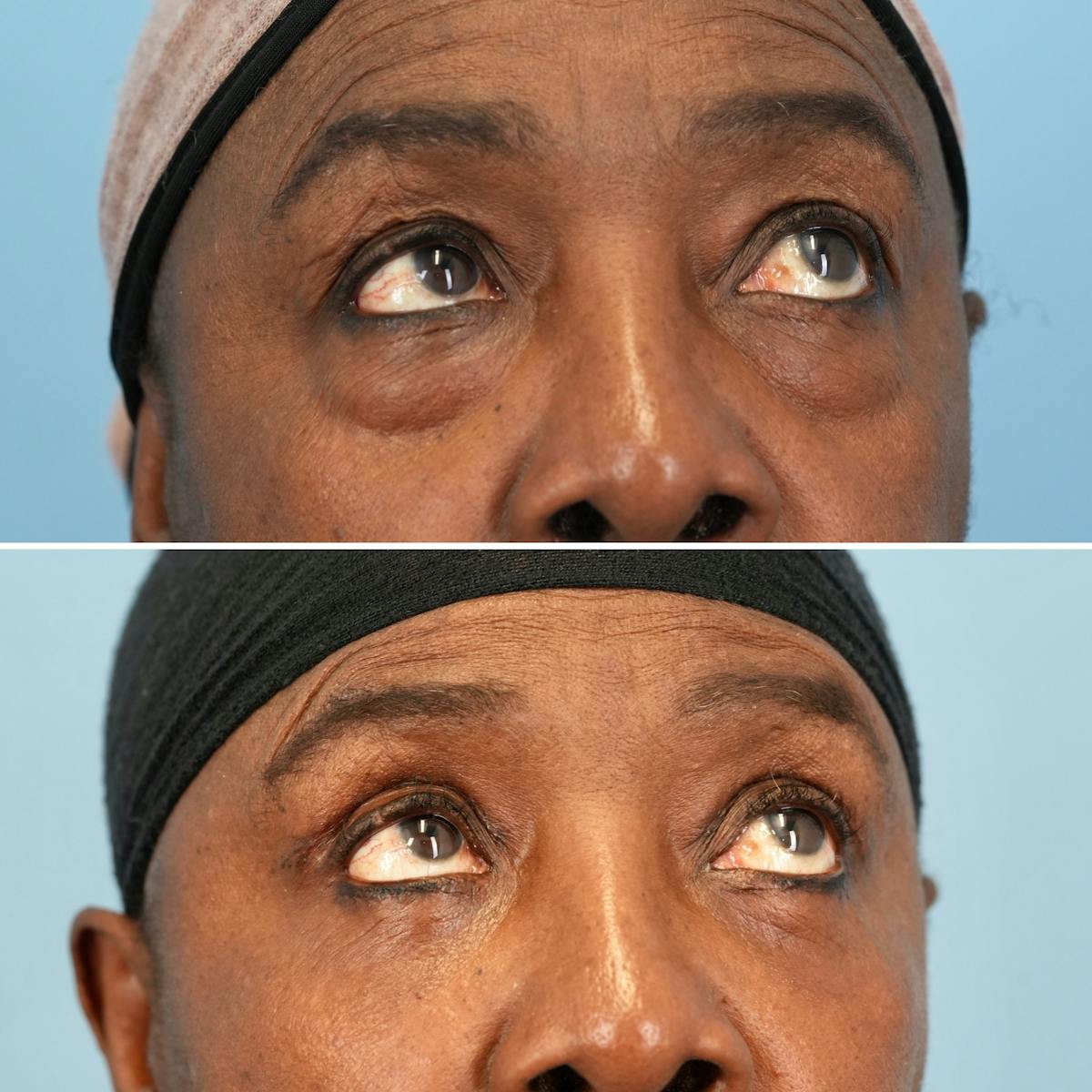 Blepharoplasty Before & After Gallery - Patient 189328 - Image 4