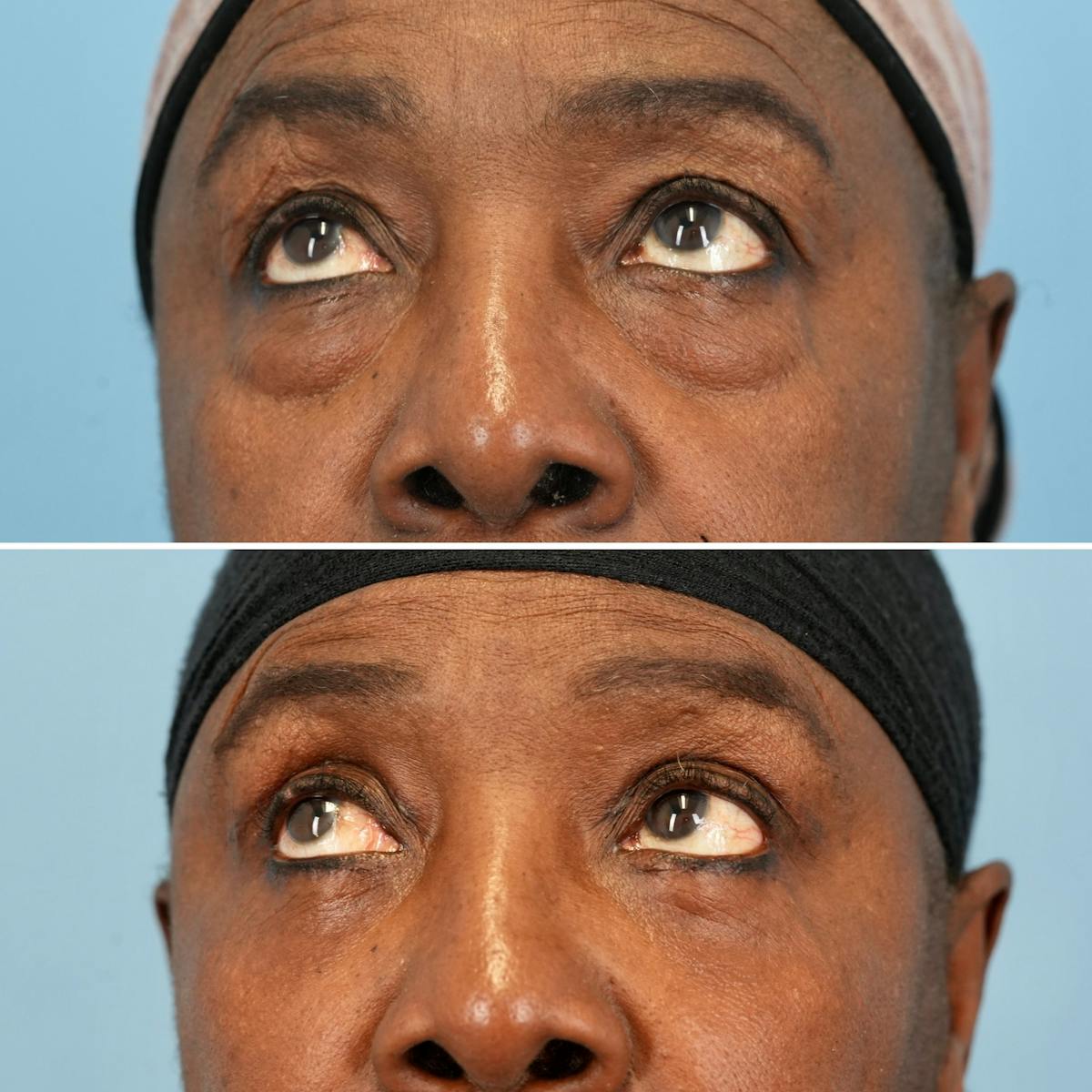Blepharoplasty Before & After Gallery - Patient 189328 - Image 5