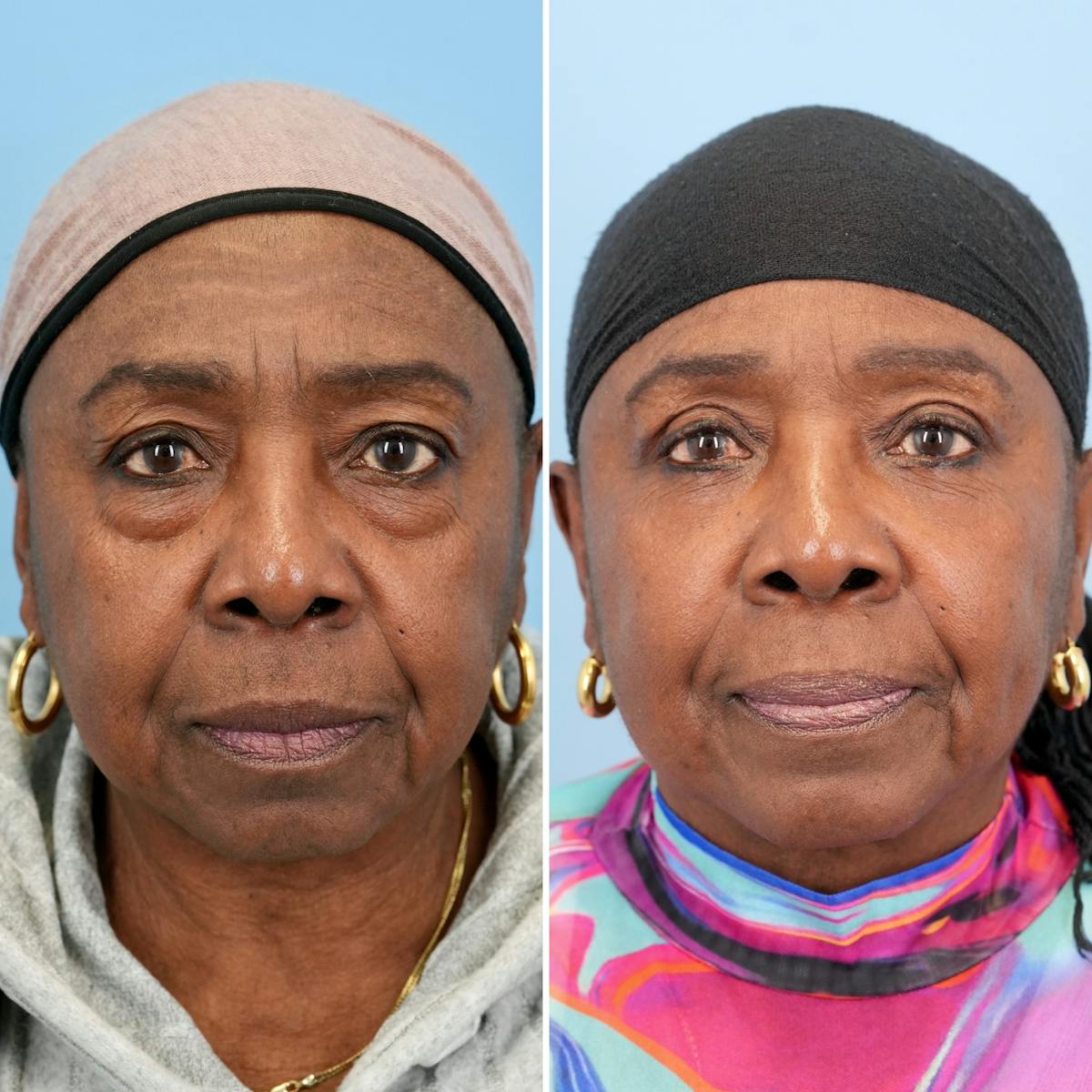 Blepharoplasty Before & After Gallery - Patient 189328 - Image 6