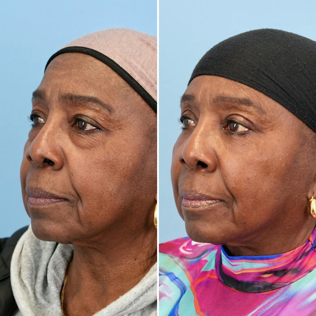 Blepharoplasty Before & After Gallery - Patient 189328 - Image 7