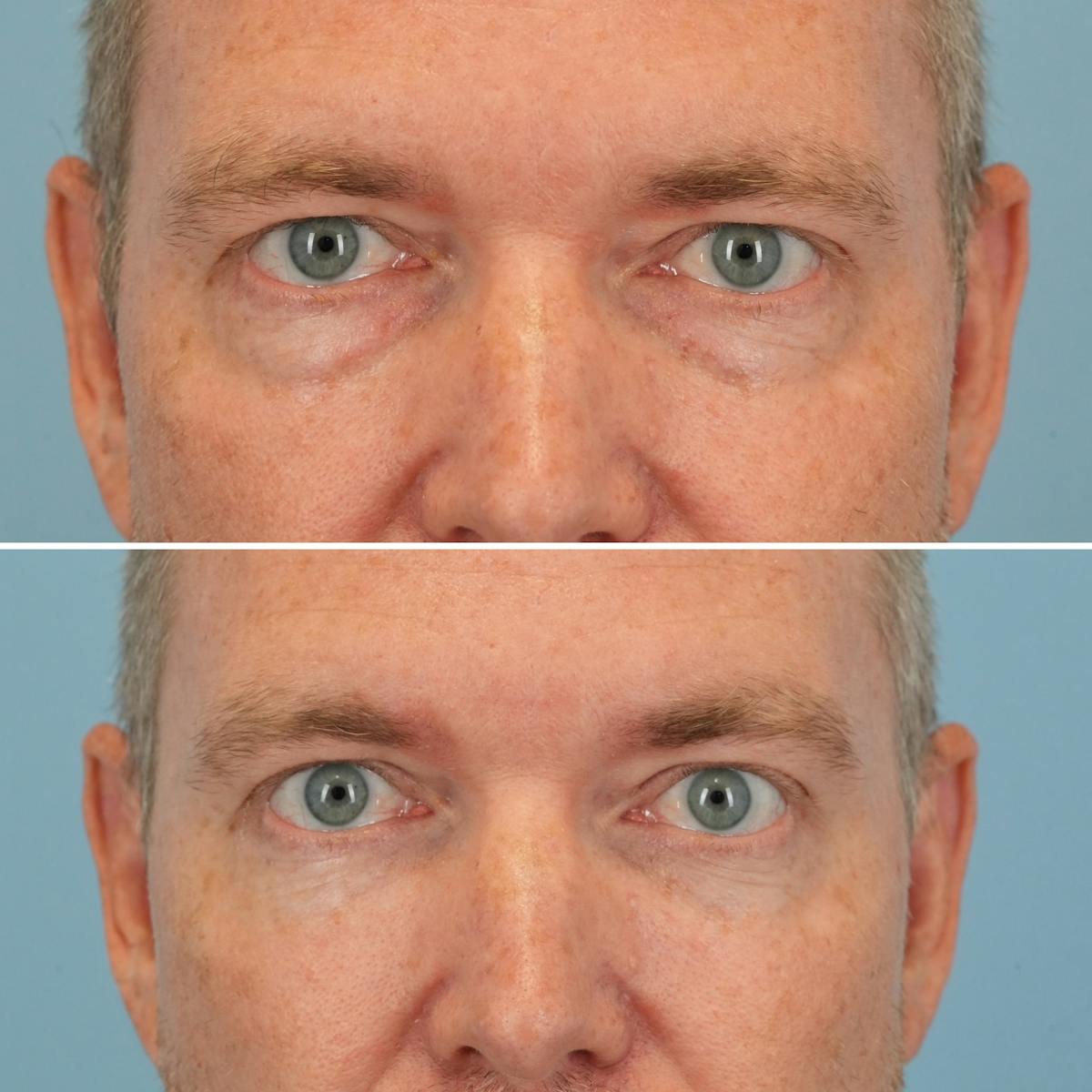 Blepharoplasty Before & After Gallery - Patient 393538 - Image 1