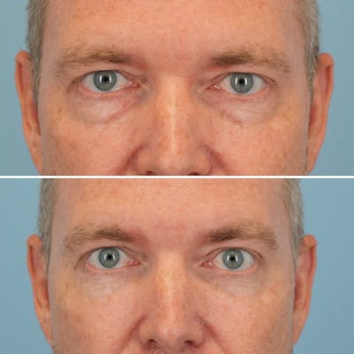 Blepharoplasty Before & After Gallery - Patient 393538 - Image 1
