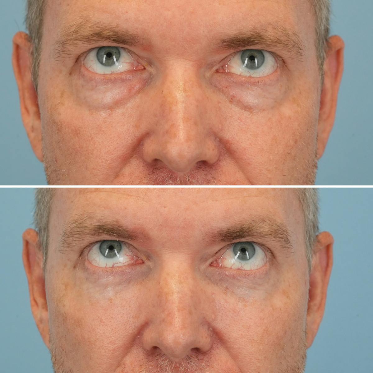 Blepharoplasty Before & After Gallery - Patient 393538 - Image 2