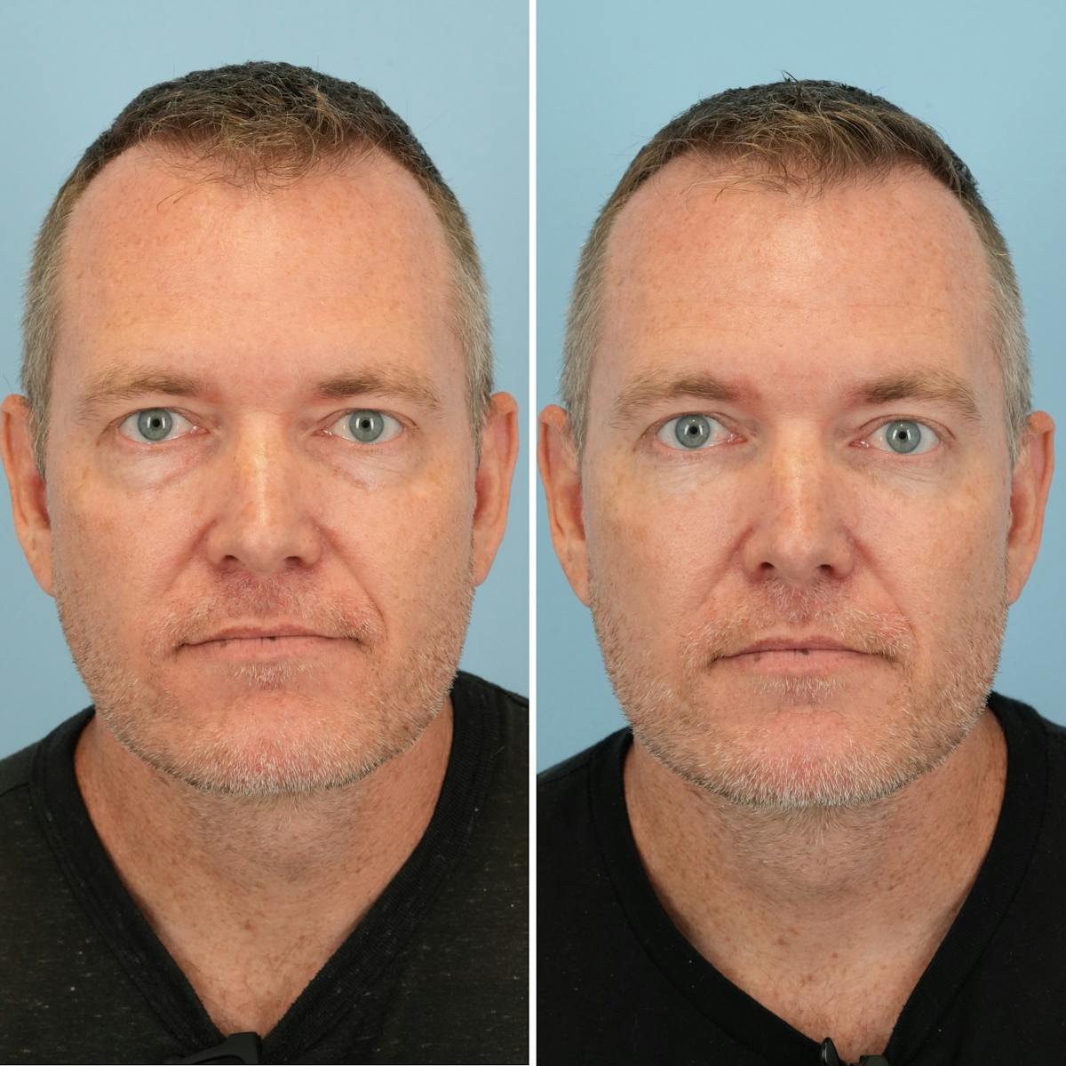 Blepharoplasty Before & After Gallery - Patient 393538 - Image 3