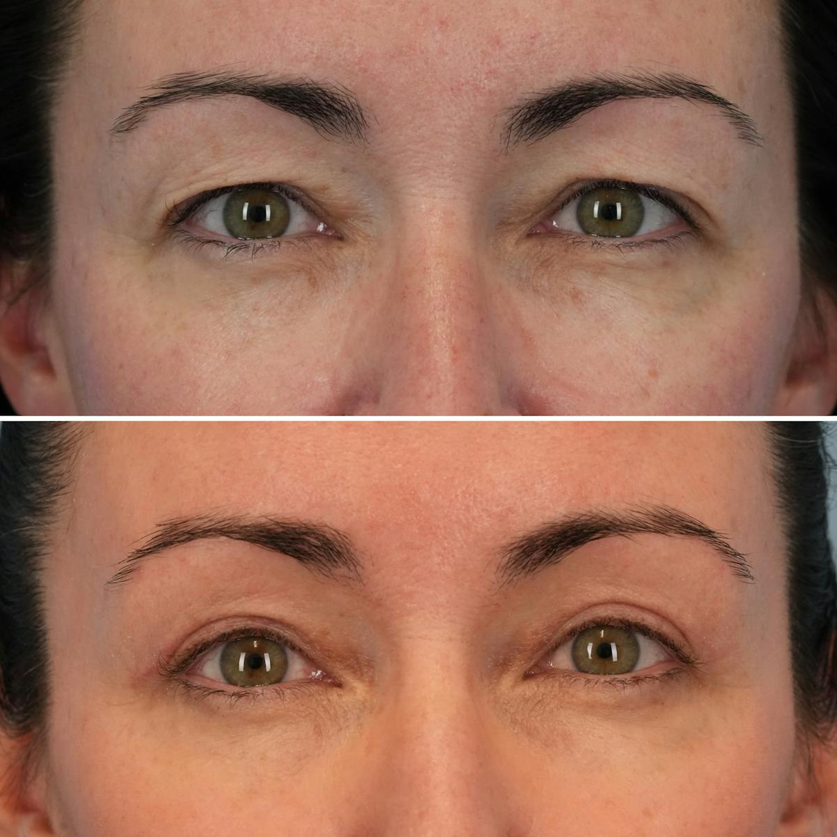 Blepharoplasty Before & After Gallery - Patient 102586 - Image 1
