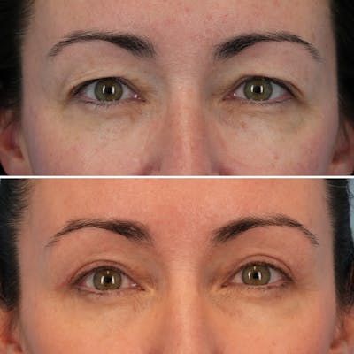 Blepharoplasty Before & After Gallery - Patient 102586 - Image 1