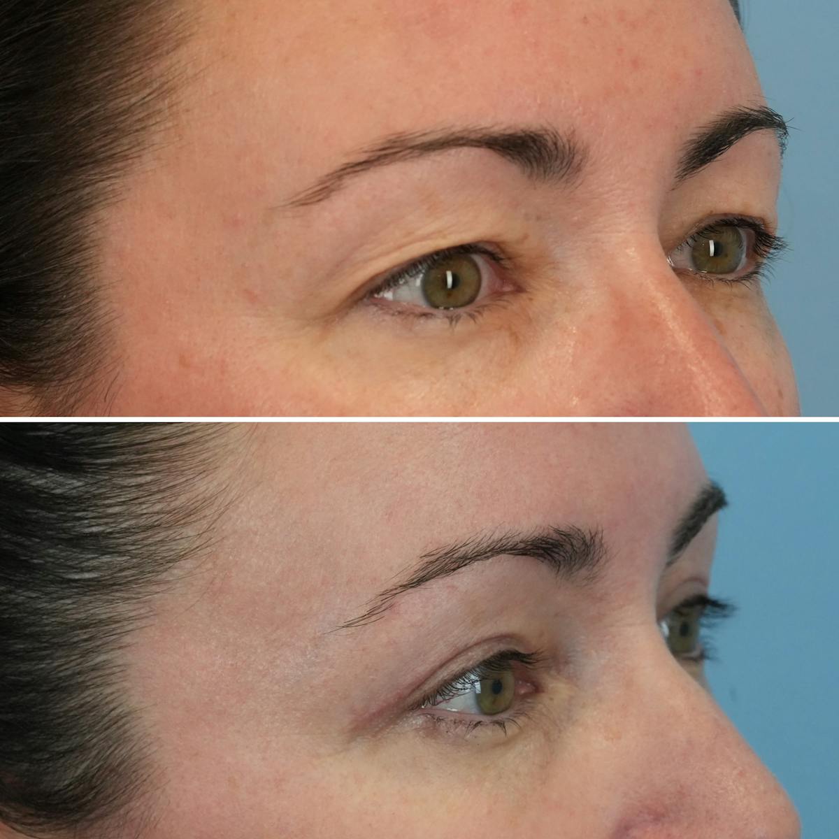 Blepharoplasty Before & After Gallery - Patient 102586 - Image 2