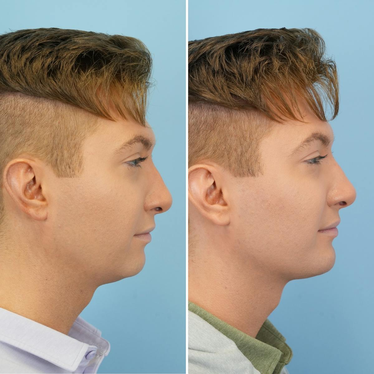 Chin Implant Before & After Gallery - Patient 310385 - Image 3