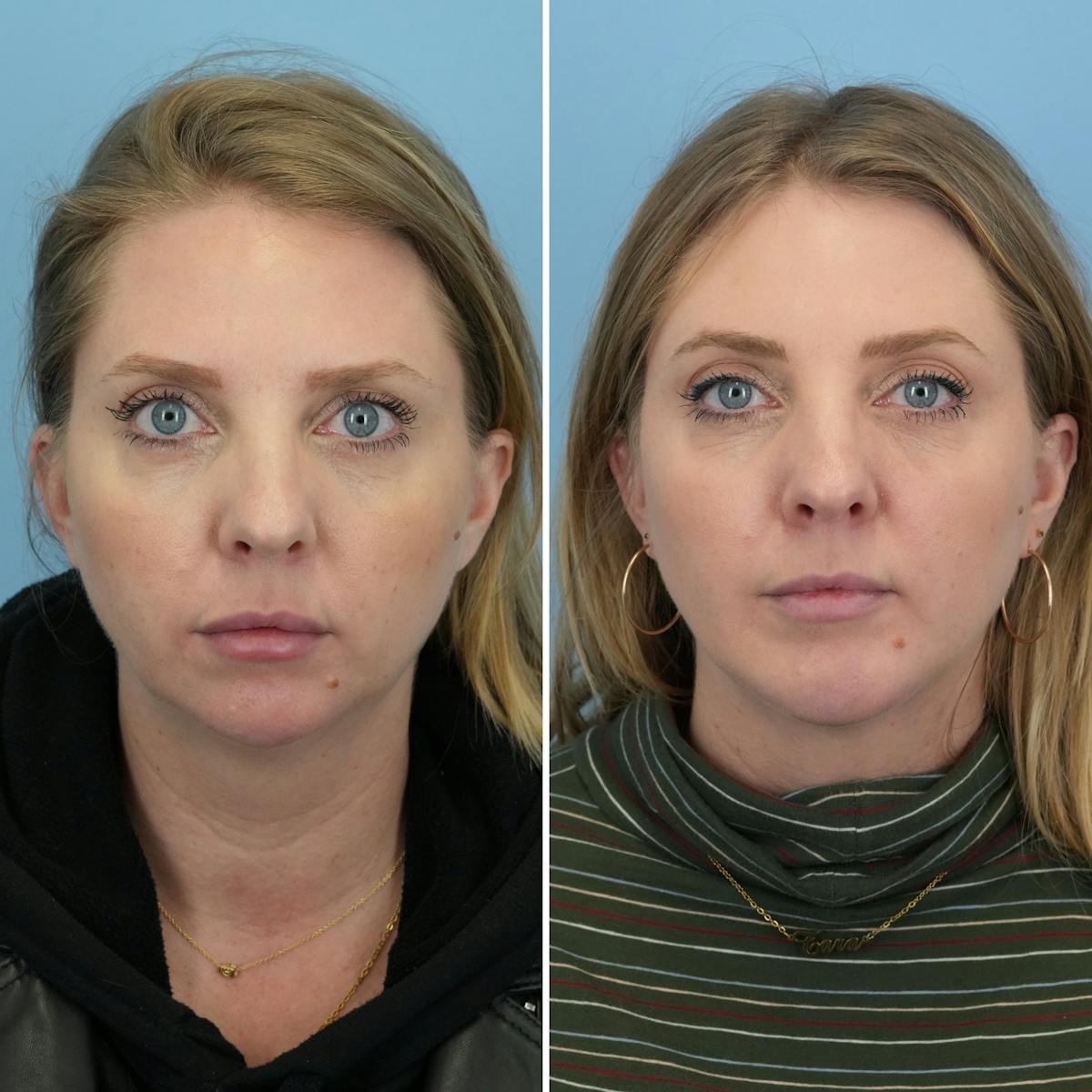 Chin Implant Before & After Gallery - Patient 151674 - Image 1