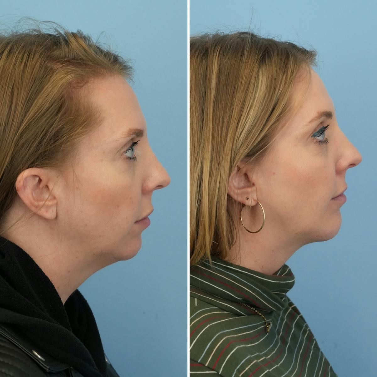Chin Implant Before & After Gallery - Patient 151674 - Image 3