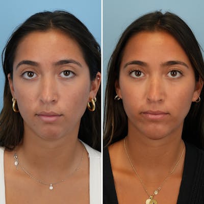 Chin Implant Before & After Gallery - Patient 452790 - Image 1