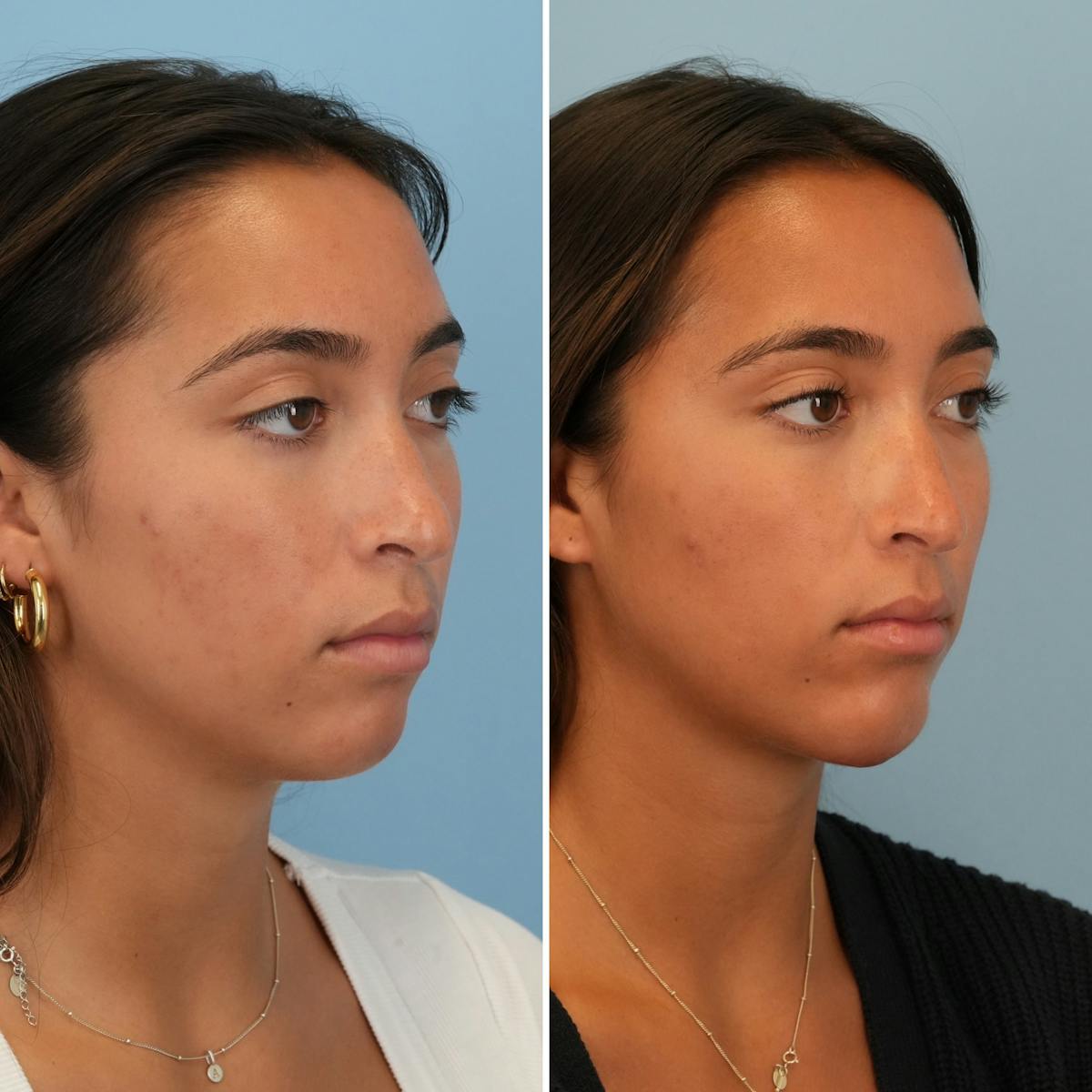 Chin Implant Before & After Gallery - Patient 452790 - Image 2