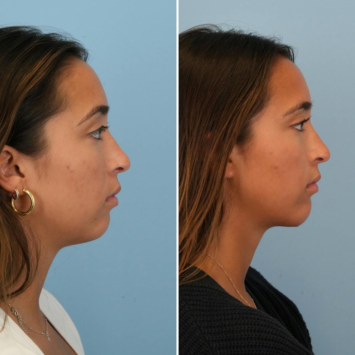 Chin Implant Before & After Gallery - Patient 452790 - Image 3