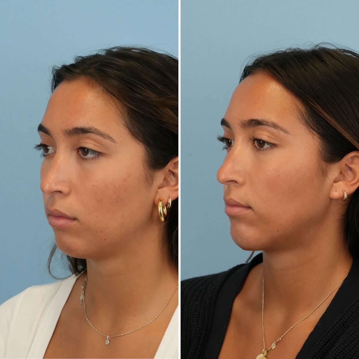 Chin Implant Before & After Gallery - Patient 452790 - Image 4
