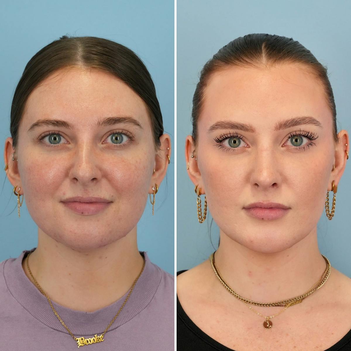 Chin Implant Before & After Gallery - Patient 424229 - Image 1