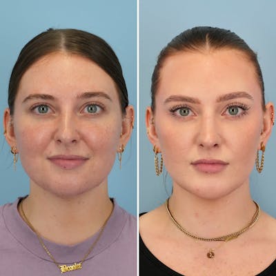 Chin Implant Before & After Gallery - Patient 424229 - Image 1