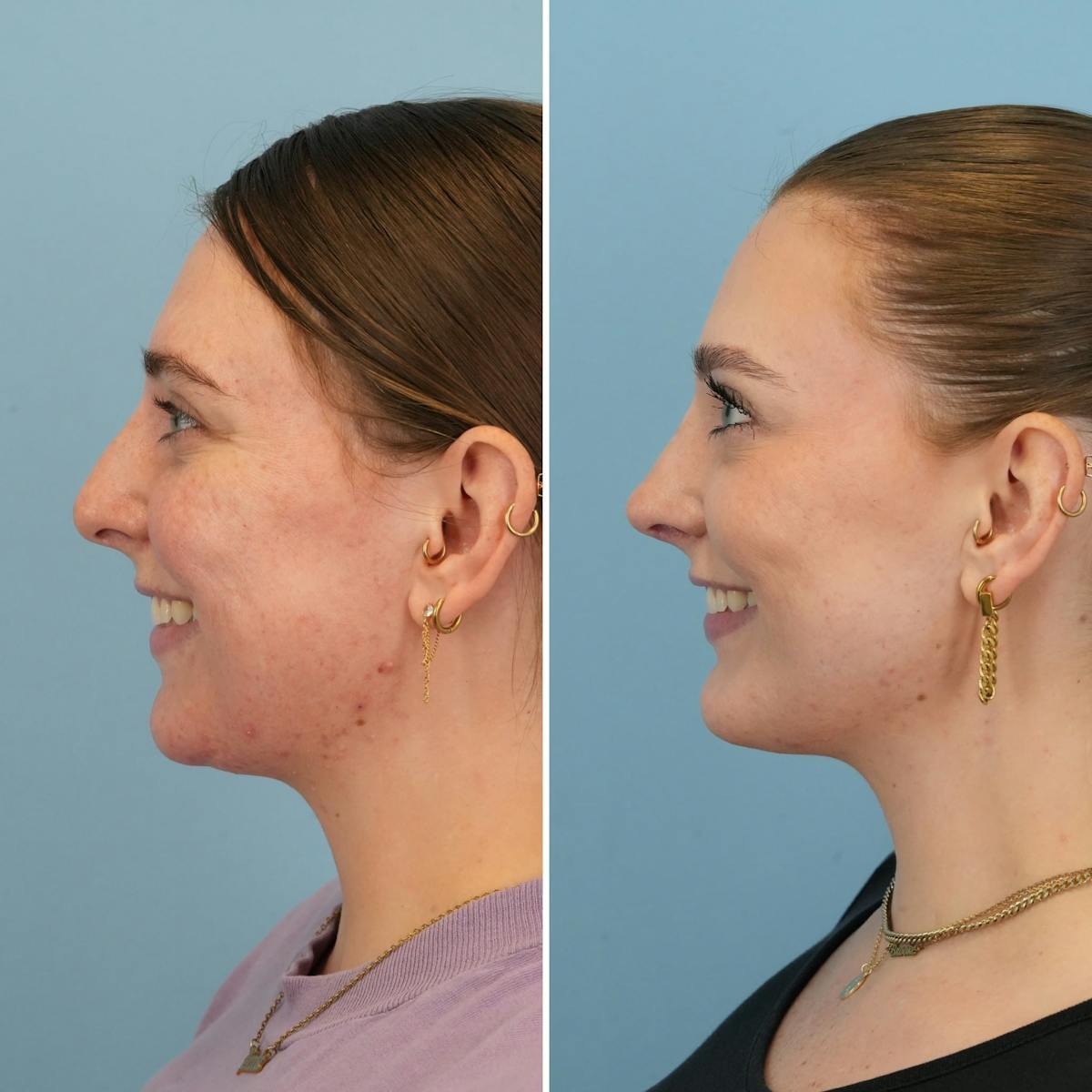 Chin Implant Before & After Gallery - Patient 424229 - Image 3