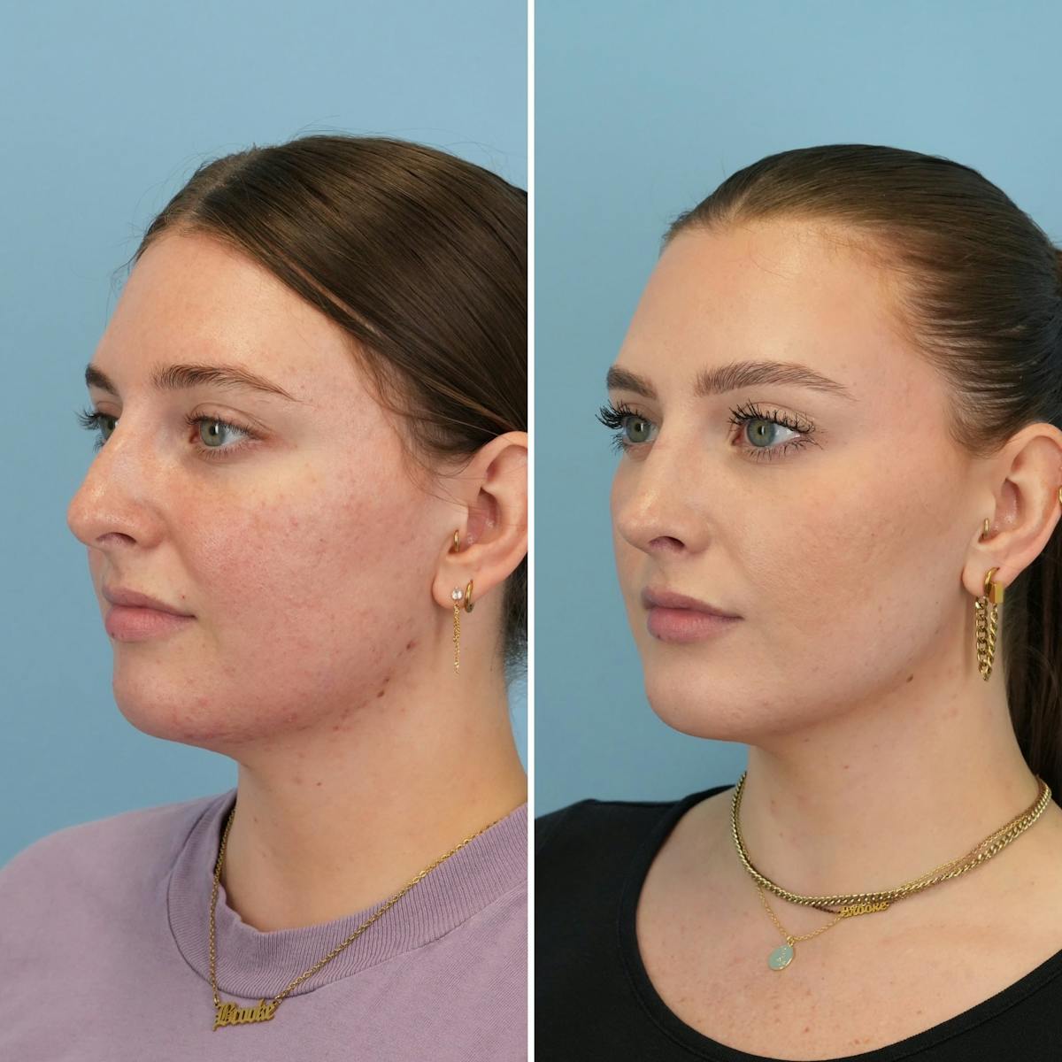 Chin Implant Before & After Gallery - Patient 424229 - Image 6