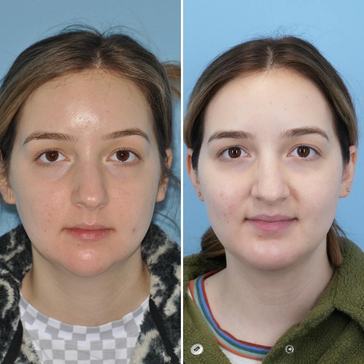 Chin Implant Before & After Gallery - Patient 384328 - Image 1