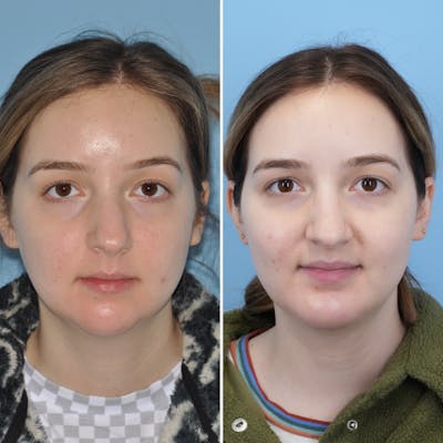 Chin Implant Before & After Gallery - Patient 384328 - Image 1
