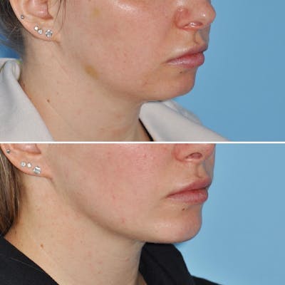 Chin Implant Before & After Gallery - Patient 736957 - Image 1