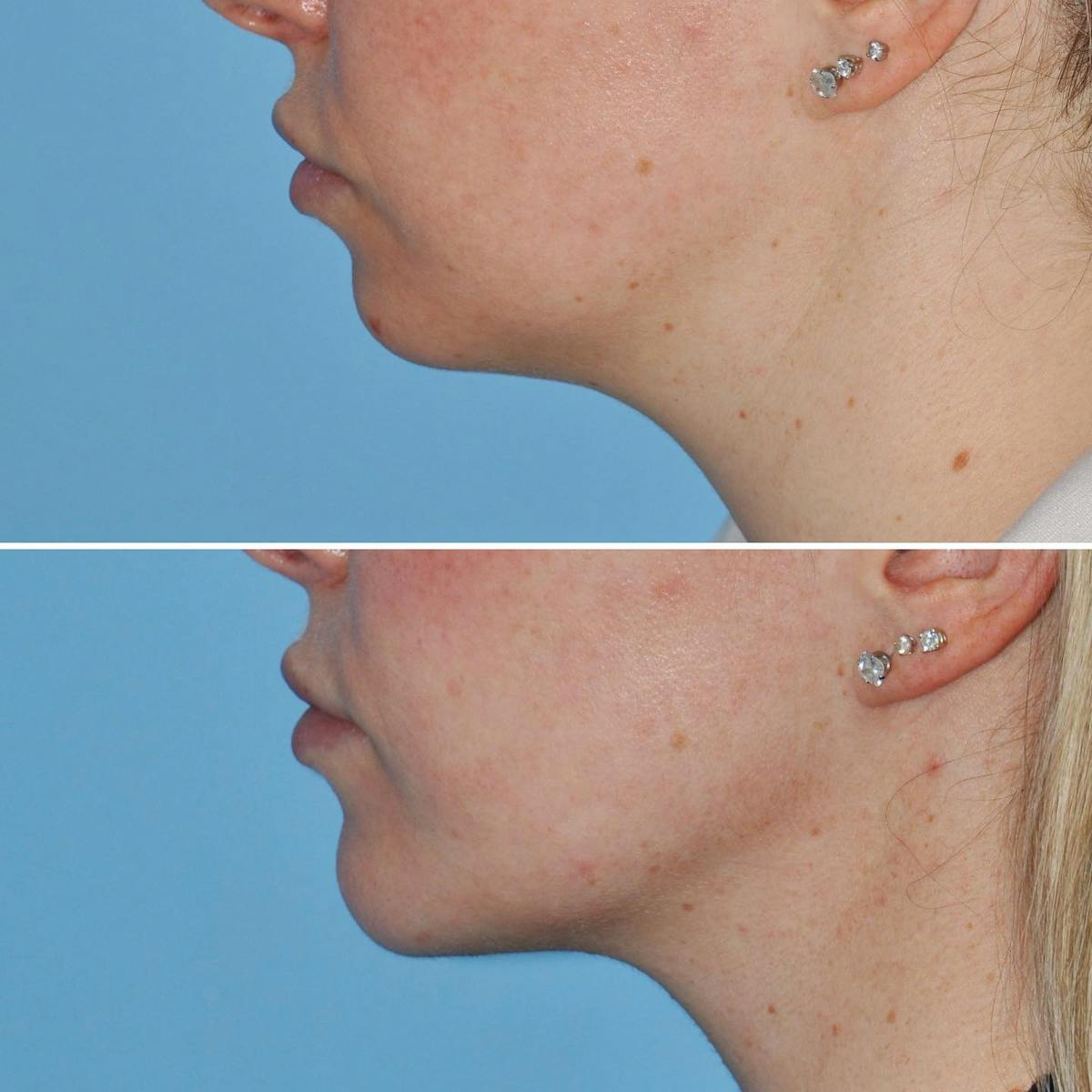 Chin Implant Before & After Gallery - Patient 736957 - Image 2