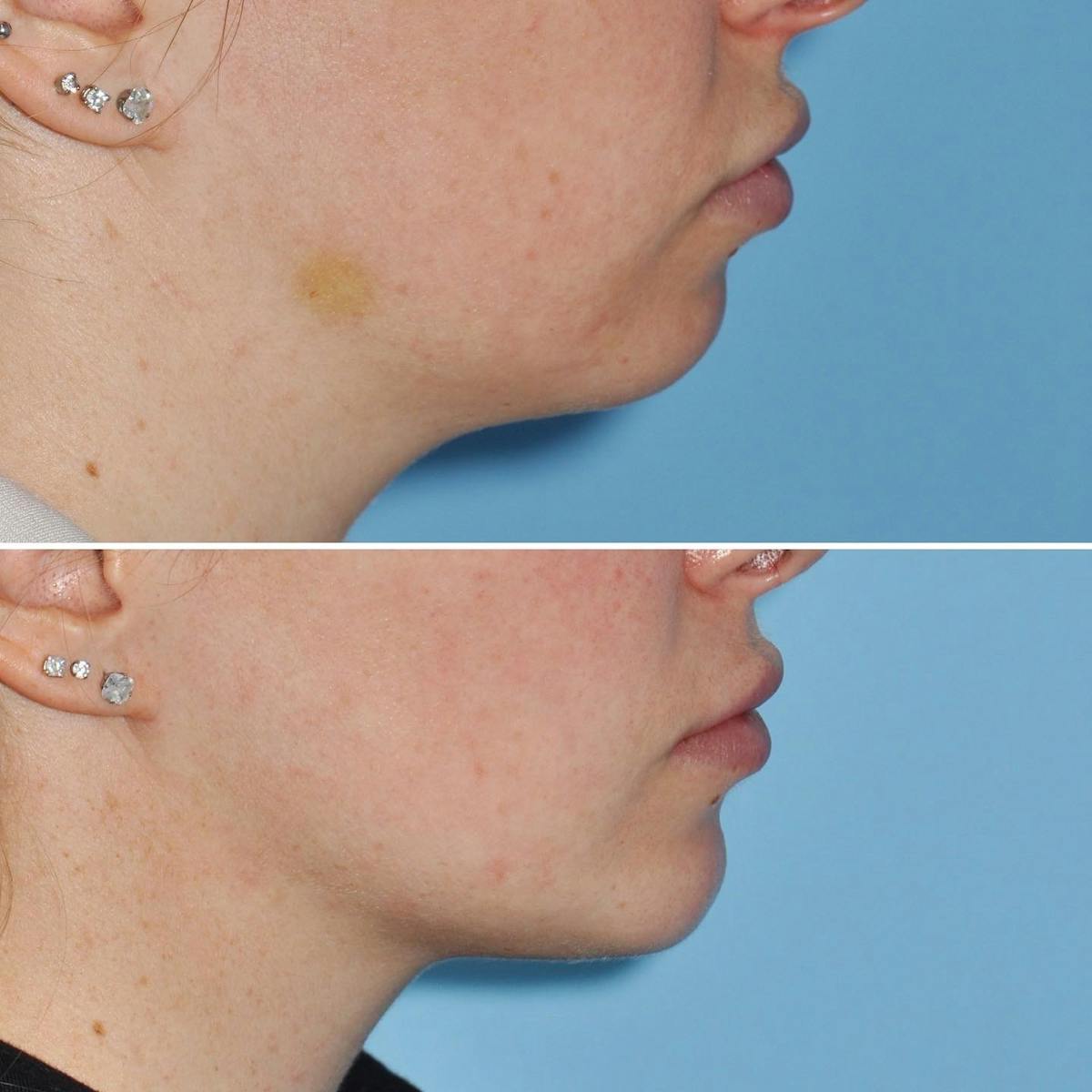 Chin Implant Before & After Gallery - Patient 736957 - Image 3