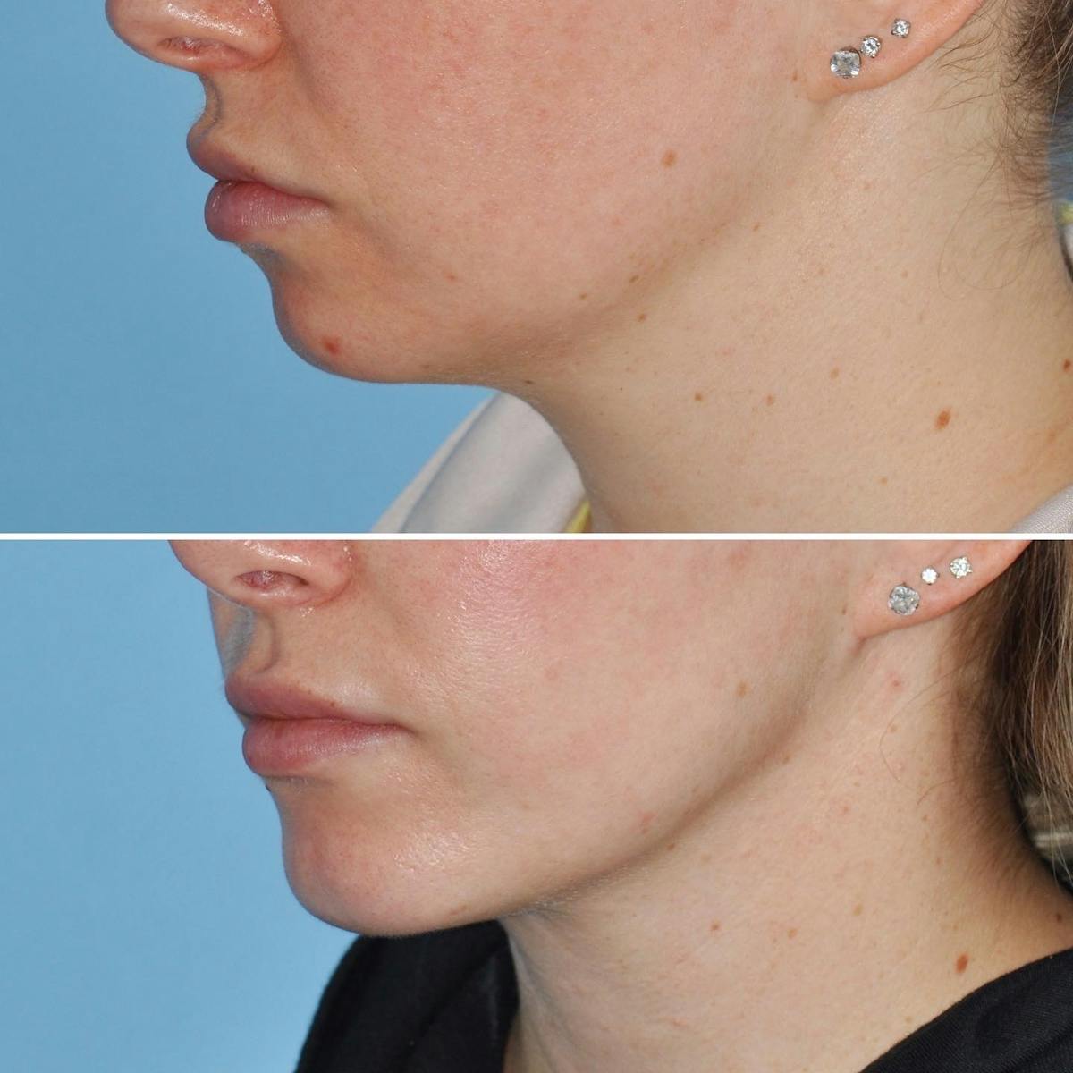 Chin Implant Before & After Gallery - Patient 736957 - Image 4