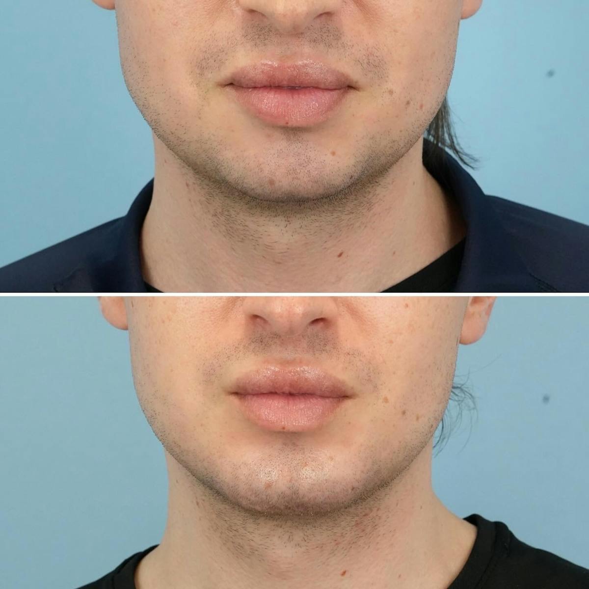 Chin Implant Before & After Gallery - Patient 493690 - Image 1