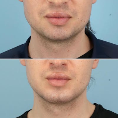 Chin Implant Before & After Gallery - Patient 493690 - Image 1