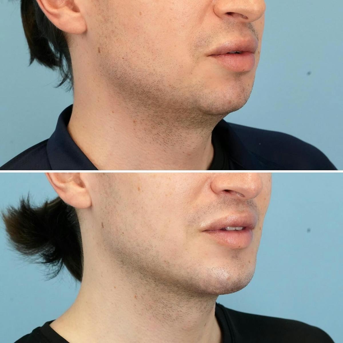 Chin Implant Before & After Gallery - Patient 493690 - Image 2