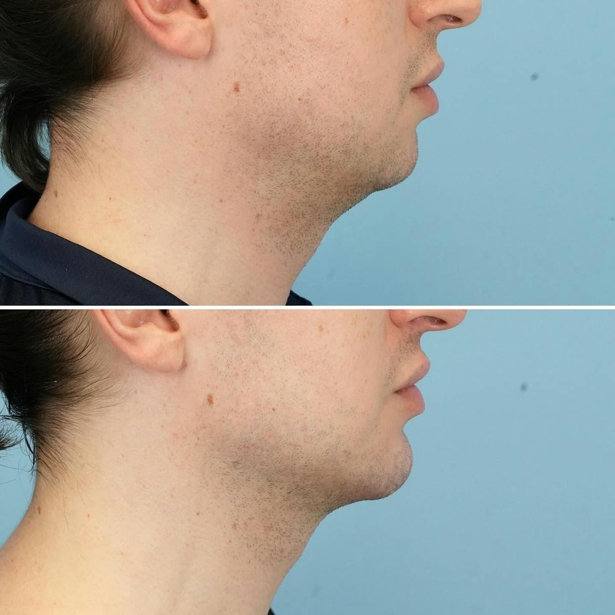 Chin Implant Before & After Gallery - Patient 493690 - Image 3