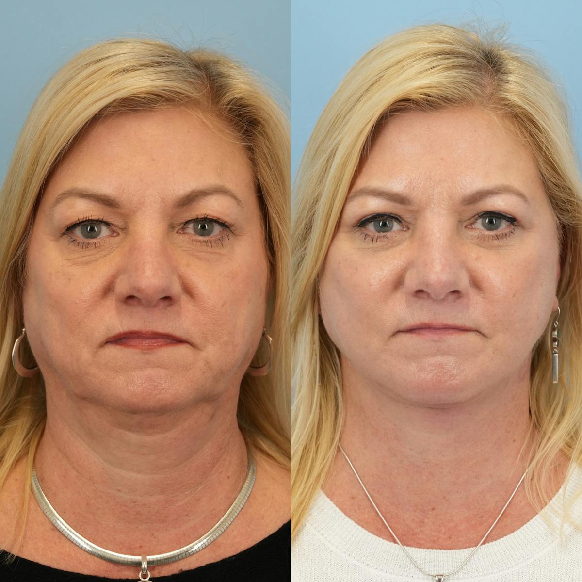 Facelift Before & After Gallery - Patient 409932 - Image 1