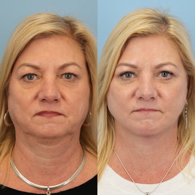 Facelift Before & After Gallery - Patient 409932 - Image 1
