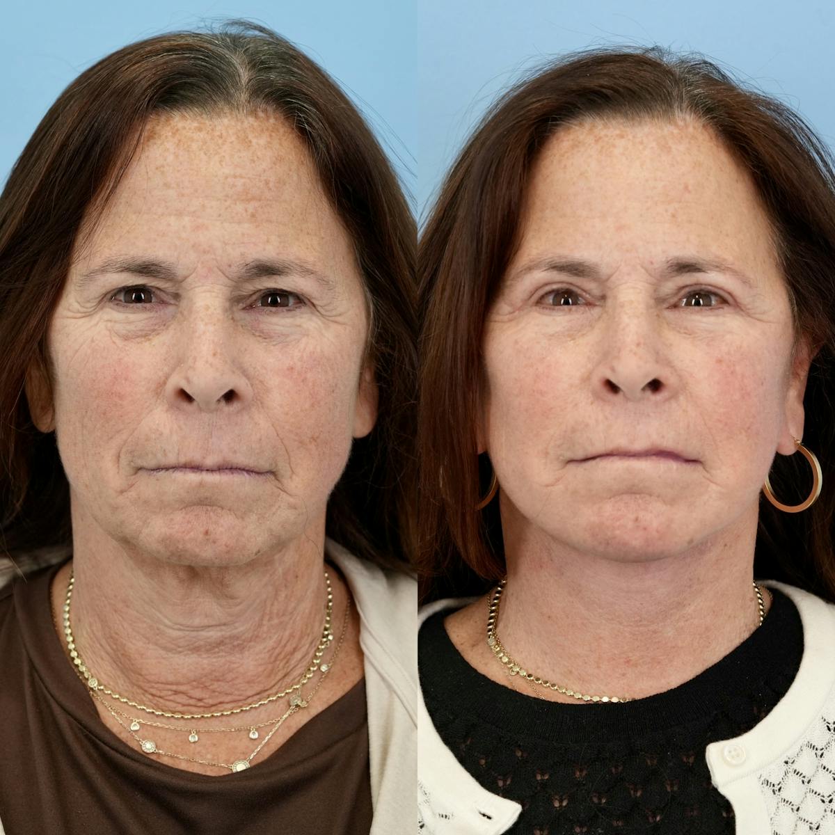 Facelift Before & After Gallery - Patient 273821 - Image 1