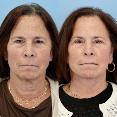 Facelift Before & After Gallery - Patient 273821 - Image 1