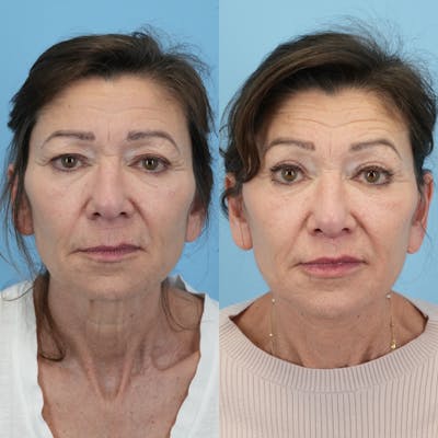 Facelift Before & After Gallery - Patient 216143 - Image 1
