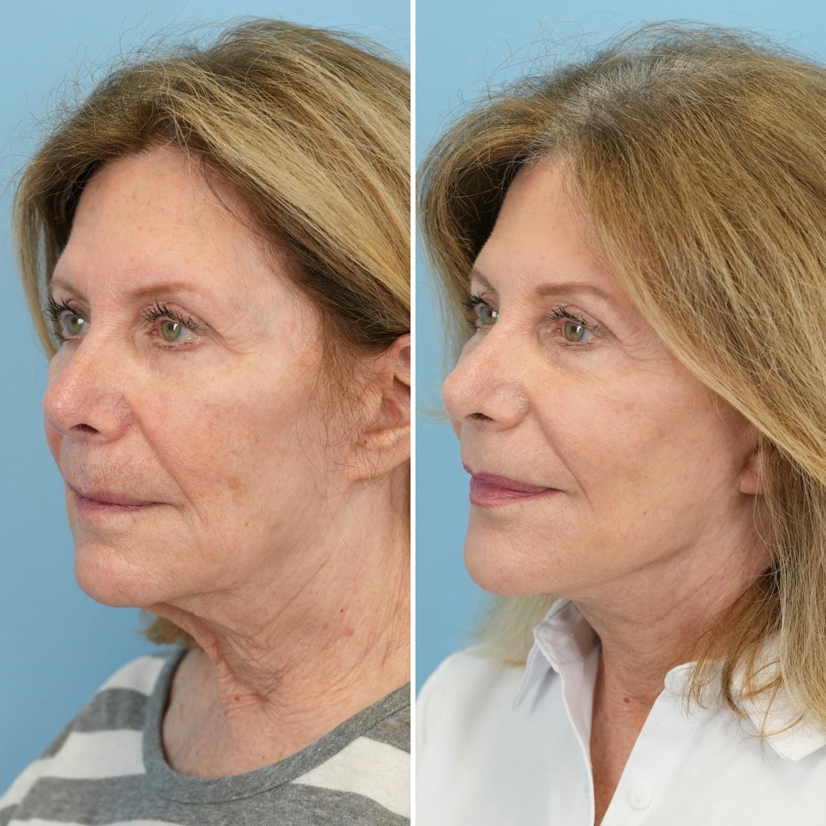 Facelift Before & After Gallery - Patient 224177 - Image 4