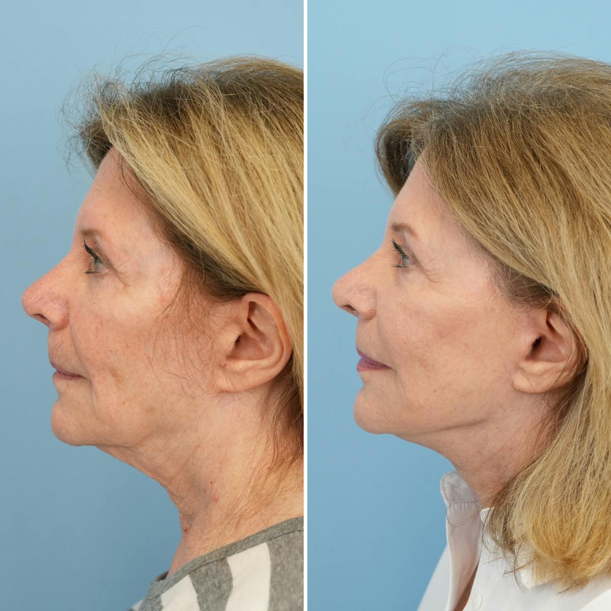 Facelift Before & After Gallery - Patient 224177 - Image 5